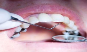 نامنظمی دندان ها حاصل بی توجهی به دندان های شیری در کودکی است