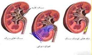 فشارخون، دیابت و کلیه سه رأس طلایی مثلث