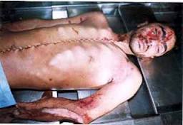 جزییات وحشتناک از قاچاق اعضای بدن سوری‌ها