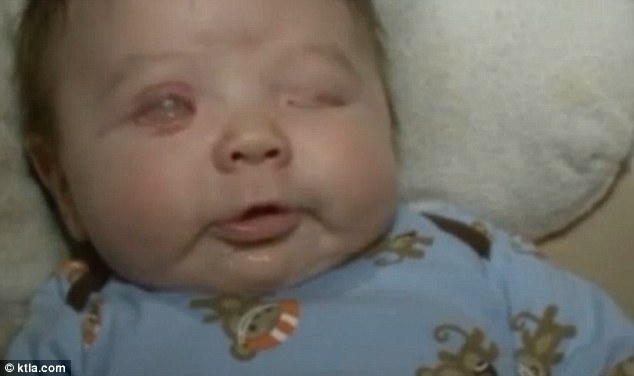 نوزادی که بدون چشم متولد شد+ تصاویر