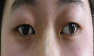 آلرژی‌های چشمی در بروز گودی و تیرگی چشم موثر است