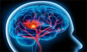 20 درصد از سکته‌های مغزی مربوط به سنین زیر 50 سال است/فرصت 3ساعته برای درمان سکته حاد مغزی
