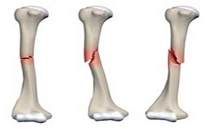 استفاده از ژل سلول بنیادی برای ترمیم شکستگی استخوان