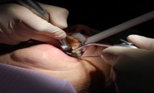 شورای سلامت دهان و دندان تشکیل شده است /درمان‌های دندانپزشکی تحت پوشش بیمه قرار می‌گیرند