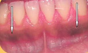 درمان نشدن بیماری‌های لثه موجب ریزش دندان‌ها می‌شود