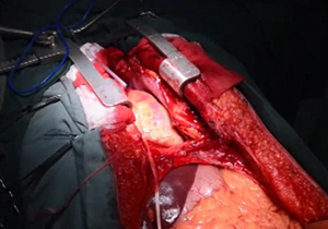 عمل جراحی پیوند قلب (۱۸+) + فیلم
