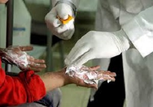 518 مراجعه به بیمارستان سوانح سوختگی طی حوادث چهارشنبه سوری