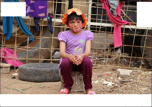 چهره سوختۀ دختر ۸ ساله سوری