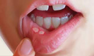 استرس مهمترین دلیل آفت دهان