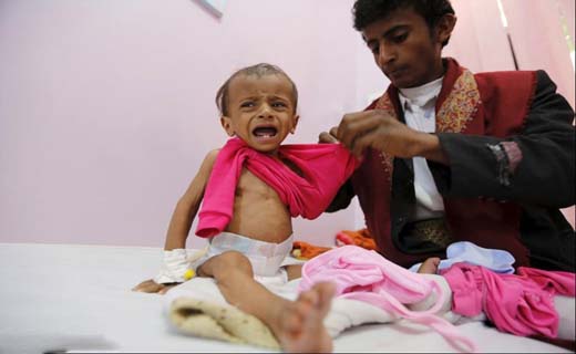 تصاویر دلخراش گرسنگی کودکان در یمن‎