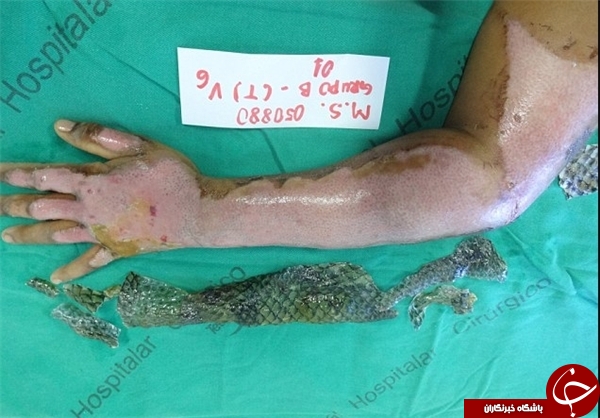 درمان سوختگی‌ با پوست ماهی تیلاپیا +تصاویر