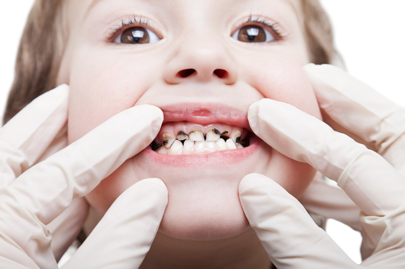 پوسیدگی دندان در کمین دندان های شیری/ وقتی پوسیدگی به دندان های شیری را نیز در امان نمی گذارد