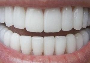 با این روش‌ها در خانه تا قبل از عید دندان‌هایتان را سفید کنید