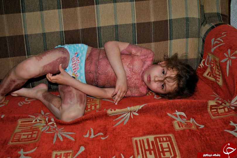 سوختگی شدید دختر 5 ساله روسی؛ عاقبت دسترسی به اینترنت + تصاویر(18+)