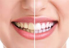 علل پوسیدگی دندان ها