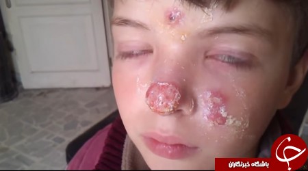 بیماری پوستی در مناطق داعش +تصاویر