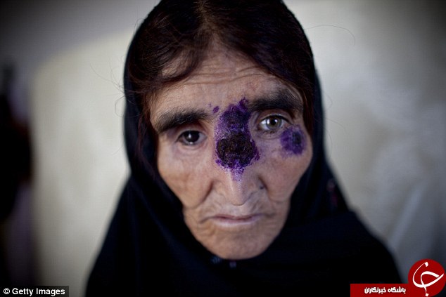 بیماری پوستی در مناطق داعش +تصاویر