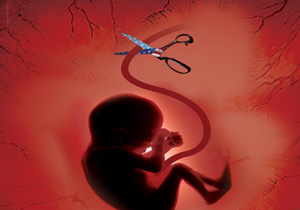 مرگ بی‌صدا با آمپولی که قلب جنین رانشانه می‌گیرد