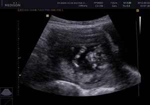 برای سقط جنین سونوگرافیست ها مدارک مستند ارائه شود