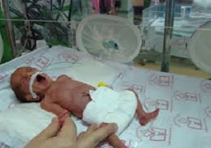 موفقیت حفظ بقای نوزادان نارس با اجرای برنامه مراقبت تکاملی یگانه نوزاد