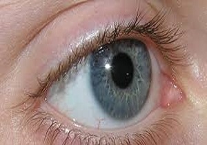 چشم دیابتی‌ها، بهترین کمینگاه "ماکولا" / دارو، خط اول درمان تورم شبکیه