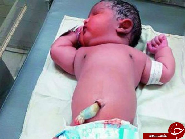 مادر دیابتی نوزاد ۶ کیلوگرمی به دنیا آورد/شگفتی پزشکان هند
