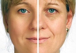 افتادگی پوست صورتتان را با "نخ" درمان کنید