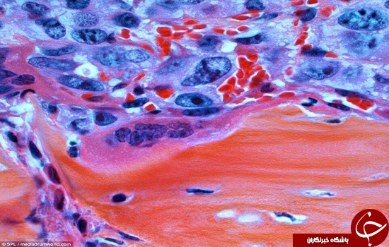 تصاویری رنگی و سه بعدی از مرگبارترین تومورهای سرطانی