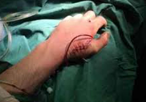 عمل موفقیت آمیز جراحی پیوند شریان دست در سقز