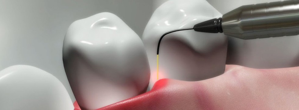 کاربرد های لیزر در درمان‌های دندان‌پزشکی/ لیزر دندان‌ها را سفید می‌کند