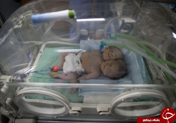 تولد نوزاد دو سر در نوار غزه +عکس