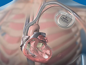 درمان تپش قلب با  روش الکتروفیزیولوژی در گلستان