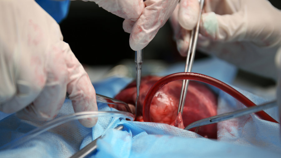 شگفت‌انگیز‌ترین اعمال جراحی پیوند اعضا در جهان