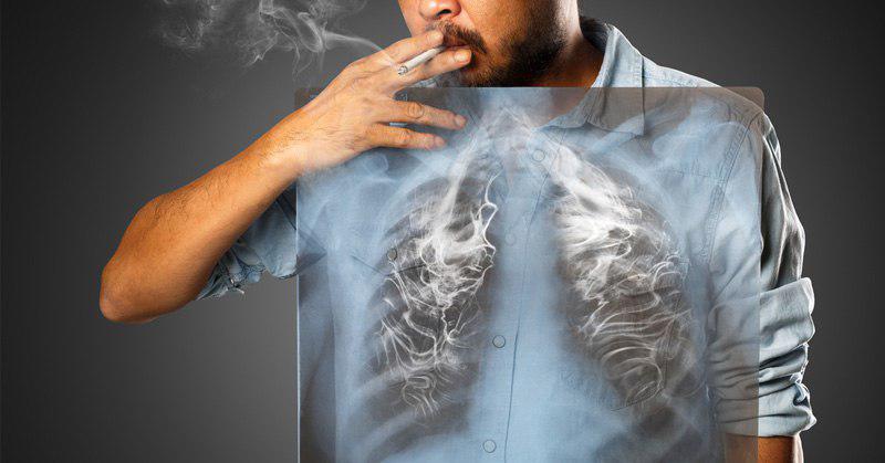 ریه افراد سیگاری زیر تیغ جراحی/دل رادیدن ندارید نبینید