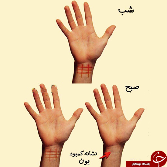 چگونه خودمان بفهمیم کمبود یون داریم؟ +عکس