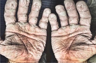 دست های قهرمان قایقرانی جهان+عکس