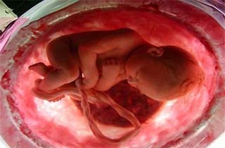مهم‌ترین عامل سقط جنین در زنان جوان