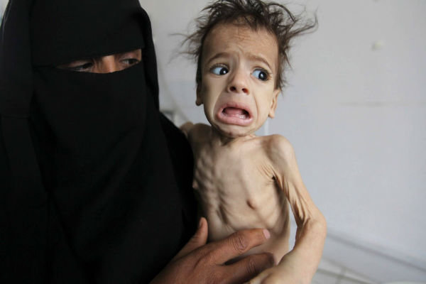 سازمان ملل: یمن در معرض بدترین گرسنگی عصر معاصر قرار دارد