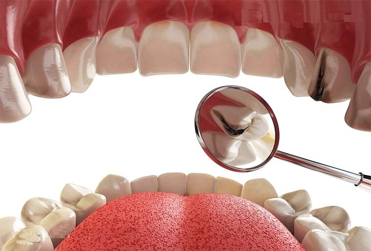6 توصیه اساسی برای جلوگیری از پوسیدگی دندان