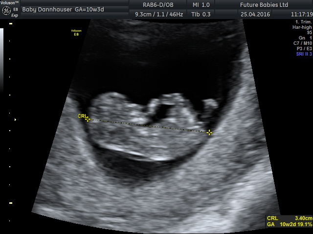 قلب کوچک جنین از هفته ششم بارداری می‌تپد/ توصیه‌هایی مهم به مادران باردار+ تصاویر