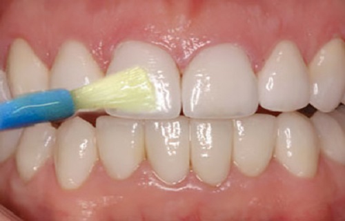 ۱۰ ماده غذایی که دندان‌هایتان را نابود می‌کند/ خرابکار‌های خندانی که به دندان آسیب می‌رسانند