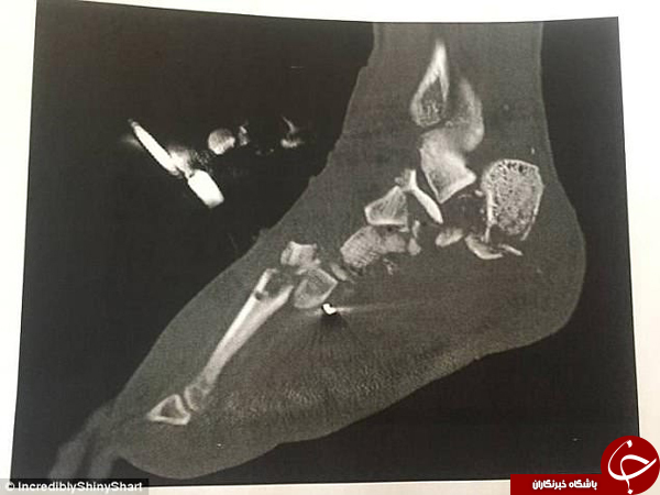 ماجرای فردی که پای خود را به خورد دوستانش داد +تصاویر