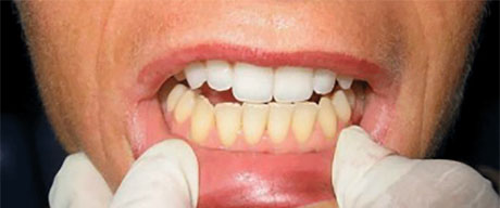 ۶ راهکار ساده برای آنکه دندان‌هایی سفید داشته باشید
