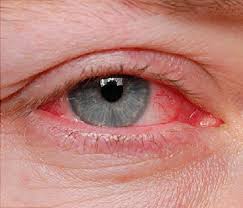 چگونه عفونت چشم را به سادگی درمان کنیم؟