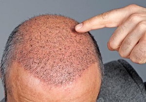 کاشت مو چه عوارضی دارد؟