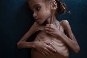 امل حسین دختر خردسال یمنی که دیگر لبخند نمی زند +تصاویر