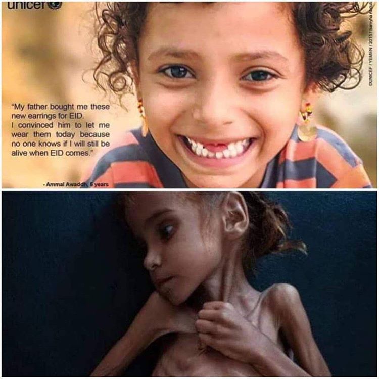 امل حسین دختر خردسال یمنی که دیگر لبخند نمی زند +تصاویر