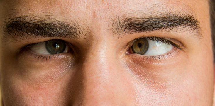 انحراف چشمی نشانه چه بیماری خطرناکی است؟