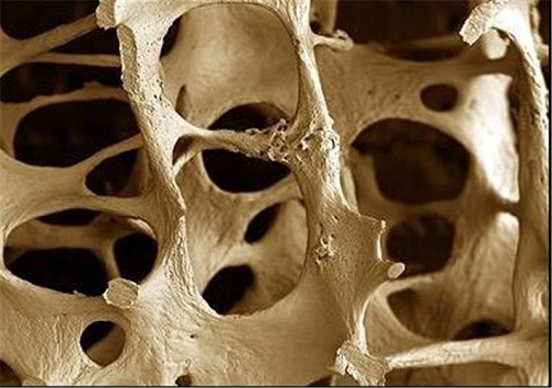 پوکی استخوان، شایع ترین بیماری در جهان