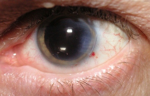 گلوکوما؛ این نام را به خاطر بسپارید/ وقتی ماهیچه‌های چشم‌هایتان ضعیف می‌شود